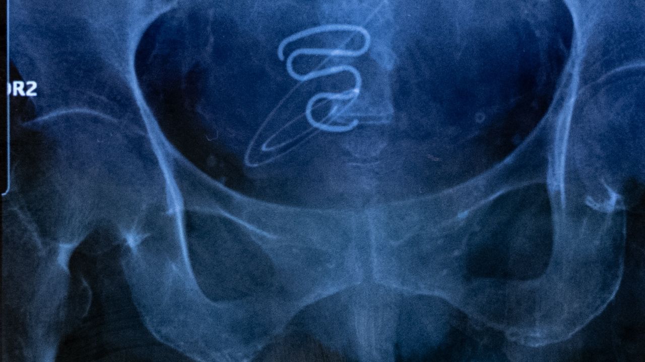 radiographie d’un stérilet spirale