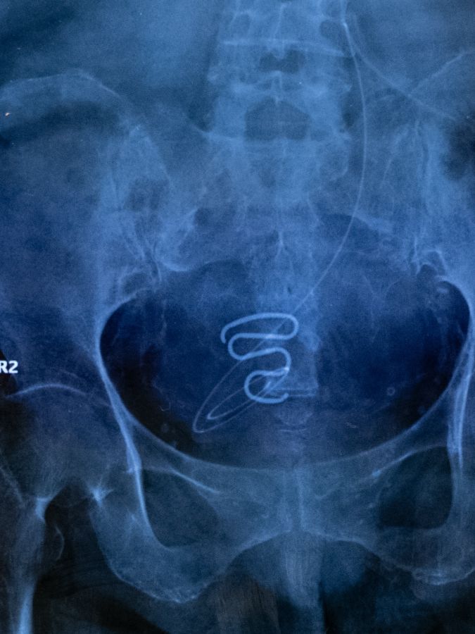 radiographie d’un stérilet spirale
