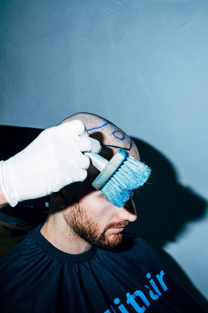 &Eacute;poussetage du cr&acirc;ne d'un patient avant implantation capillaire 